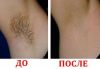 Депиляция Шугаринг. Эпиляция сахарной пастой.