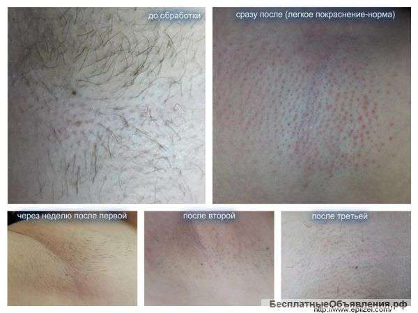 Электроэпиляция – это эффективный метод удаления волос