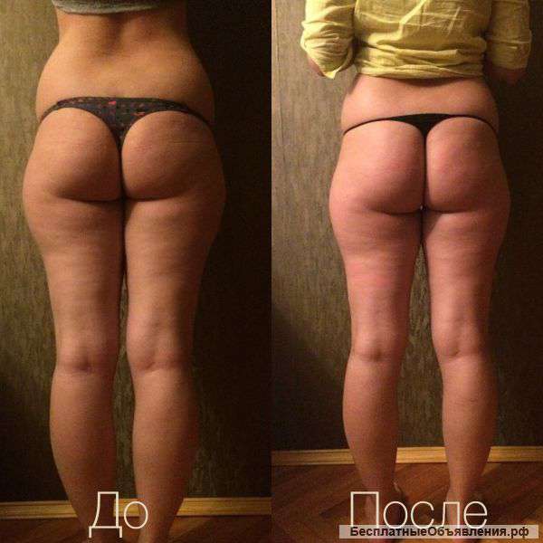 Антицеллюлитный массаж