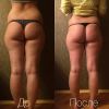Антицеллюлитный массаж