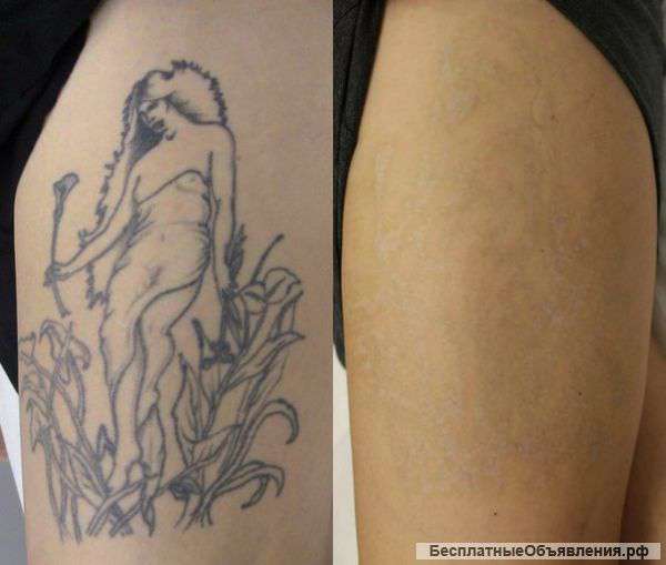 Удаление татуировок / татуаж