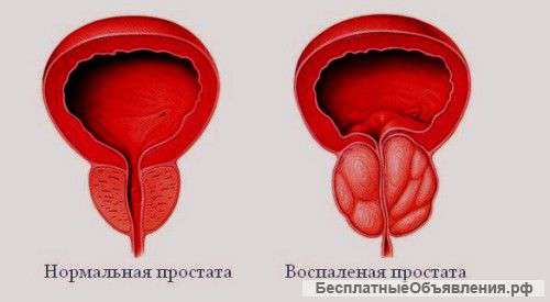 М/ч 35 лет больному хроническим простатитом требуется помощь дев