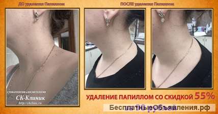 Косметология, косметолог, удаление папиллом