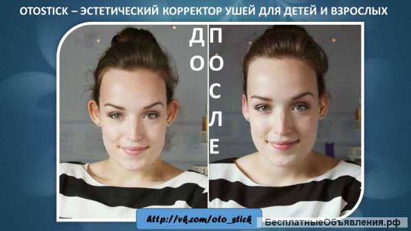 Otostick (Отостик) – корректор для ушей. АЛЬТЕРНАТИВА ОТОПЛАСТИКЕ.