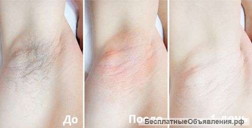 Спа-Шугаринг