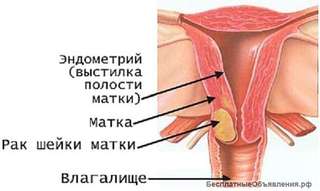 Рак шейки матки. Лечение.