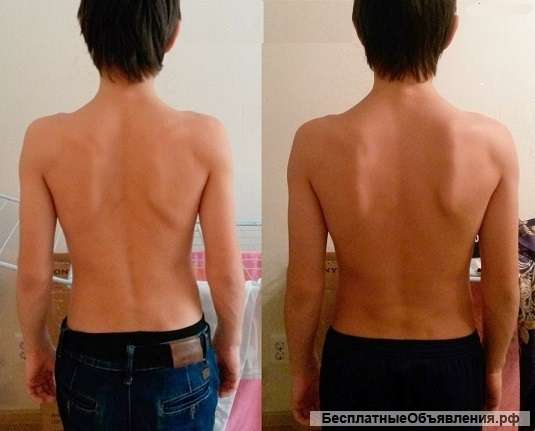 Правка атланта по методике атласпрофилакс