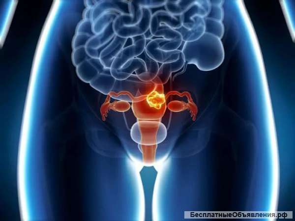 Лечение рака эндометрия (рака тела матки) в Харбине