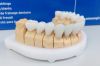 Безметалловая керамика CEREC на Имплантатах