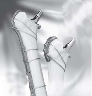 Набор для остеосинтеза трубчатых костей