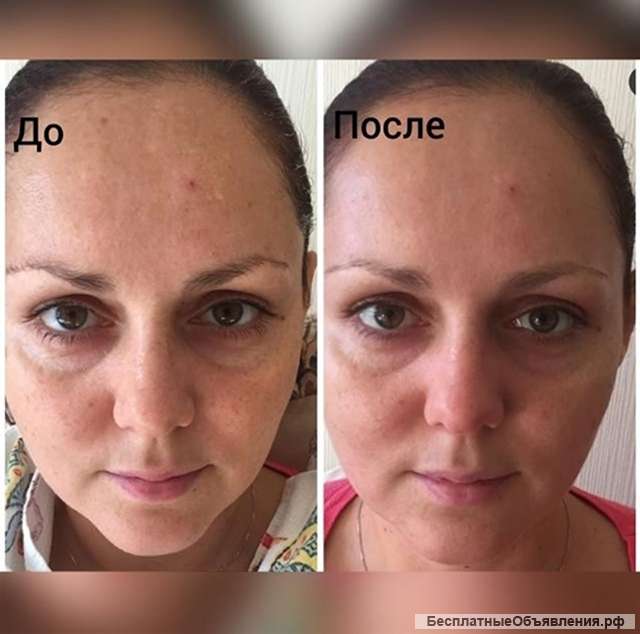Ультразвуковая чистка лица