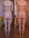 Коррекция фигуры ,:вакуумно-роликовый массаж,прессотерапия,похудение