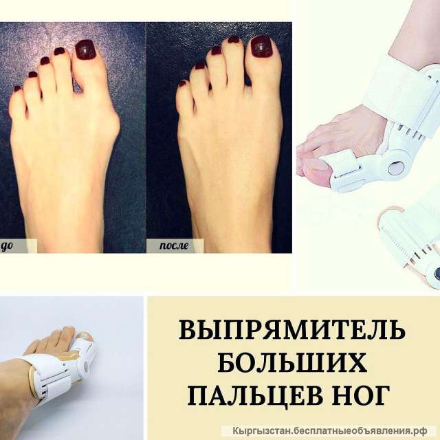 Выпрямитель больших пальцев ног