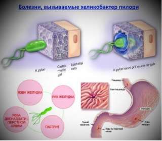 Альтернативное лечение хеликобактер пилори