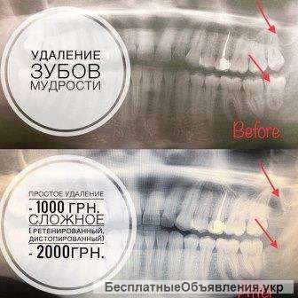 Удаление зубов мудрости