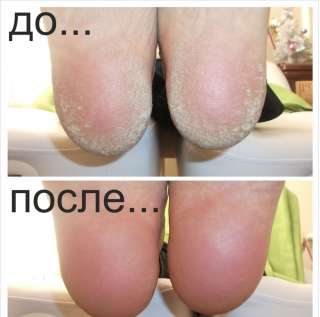 Преглашаю на педикюр