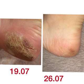 Решение проблем с ногтями и стопами в Алматы