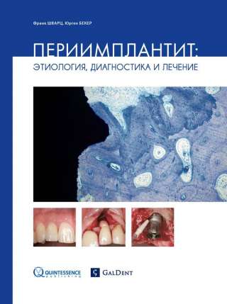 Шварц Ф. Бекер Ю. Периимплантит: этиология, диагностика и лечение.
