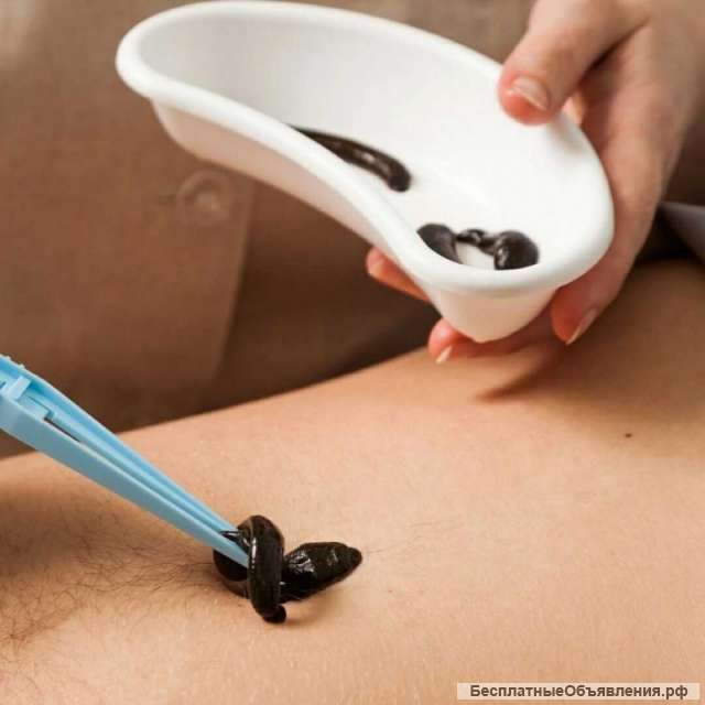 Гирудотерапия - лечение пиявками