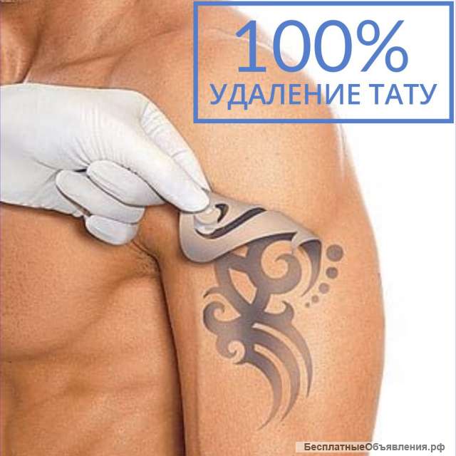 Удаление татуировок
