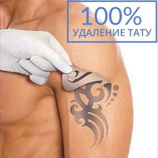 Удаление татуировок
