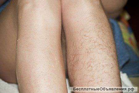 Шугаринг (сахарная депиляция)