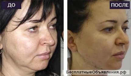 Косметология, подтяжка лица