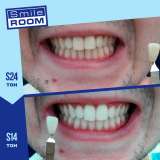 Косметическое отбеливание зубов на 4-30 тонов