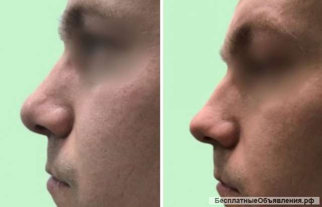 Ринопластика спб