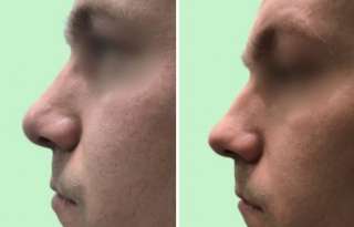 Ринопластика спб