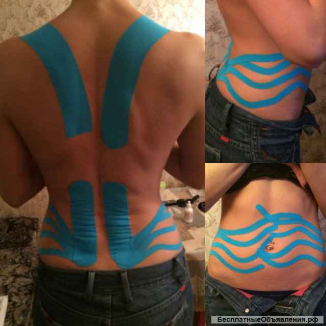 Кинезиотейпирование