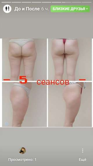 Массаж аппаратный