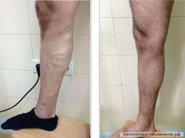 Лечение варикоза