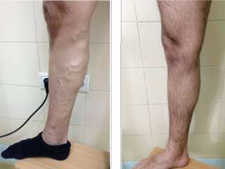 Лечение варикоза