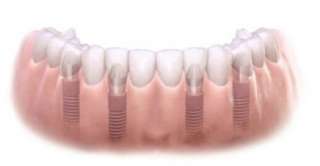 Полное протезирование зубов