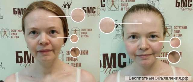 Аппаратный массаж лица. Биомеханическая стимуляция мышц головы, шеи и лица аппаратом Назарова