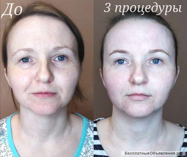 Аппаратный массаж лица. Биомеханическая стимуляция мышц головы, шеи и лица аппаратом Назарова