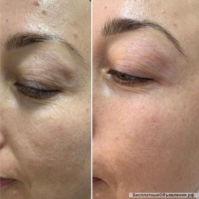 Аппаратный массаж лица. Биомеханическая стимуляция мышц головы, шеи и лица аппаратом Назарова