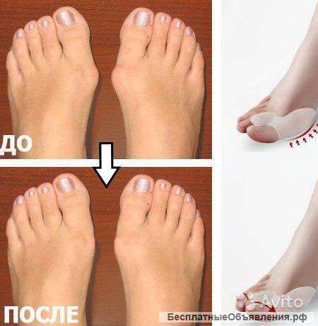 Фиксатор Valgus Pro