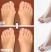 Фиксатор Valgus Pro