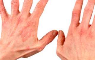 Приём врачом дерматологом, анонимно