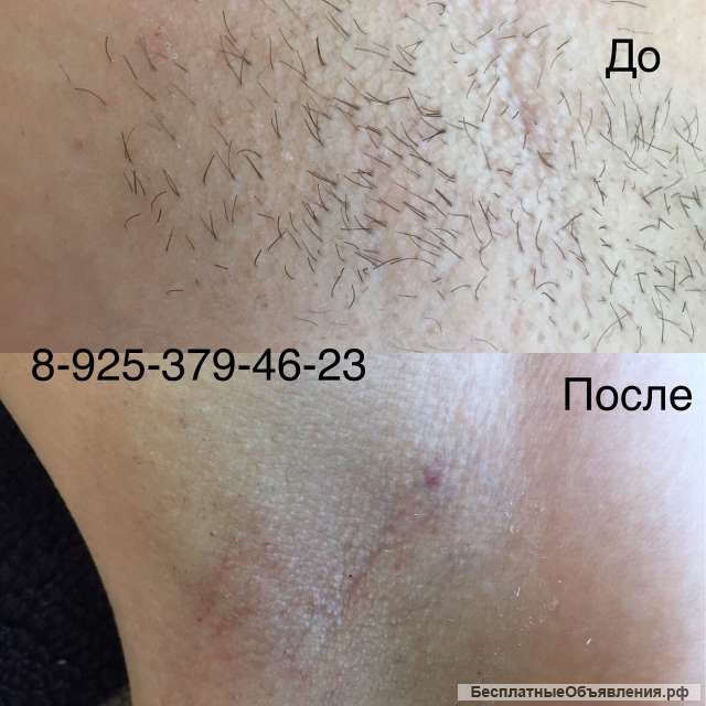Электроэпиляция