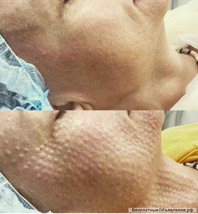 Увлажняем Вашу кожу гиалуроновой кислотой