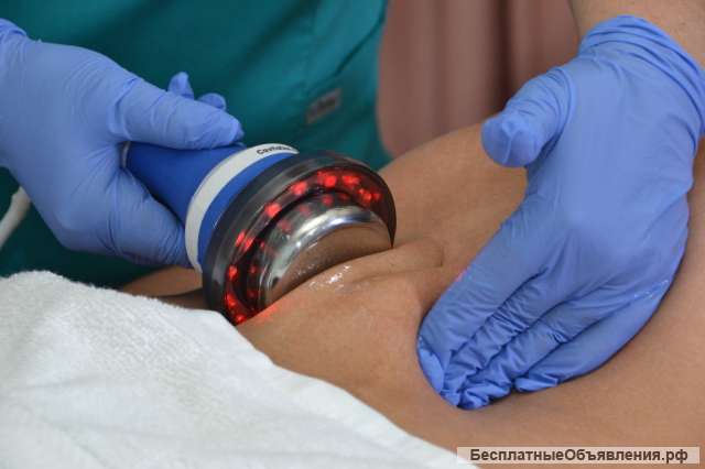 Криолиполис, кавитация, RF лифтинг лица и тела, LPG массаж