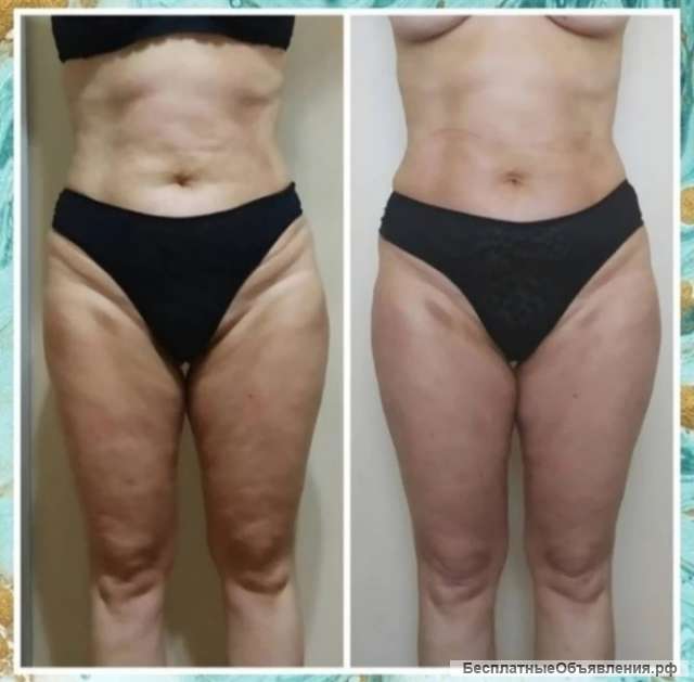 Аппаратный массаж