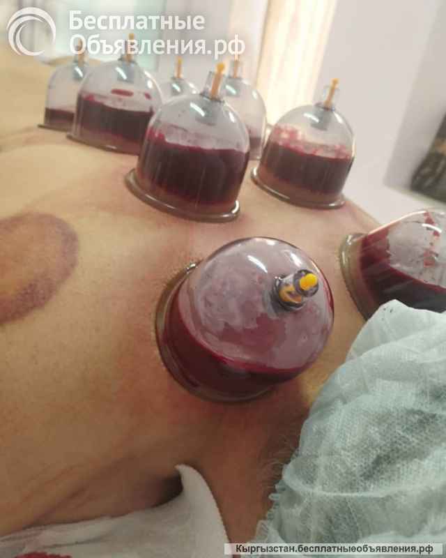 Все виды массажа. Хиджама. Мастера с опытом 12 лет.