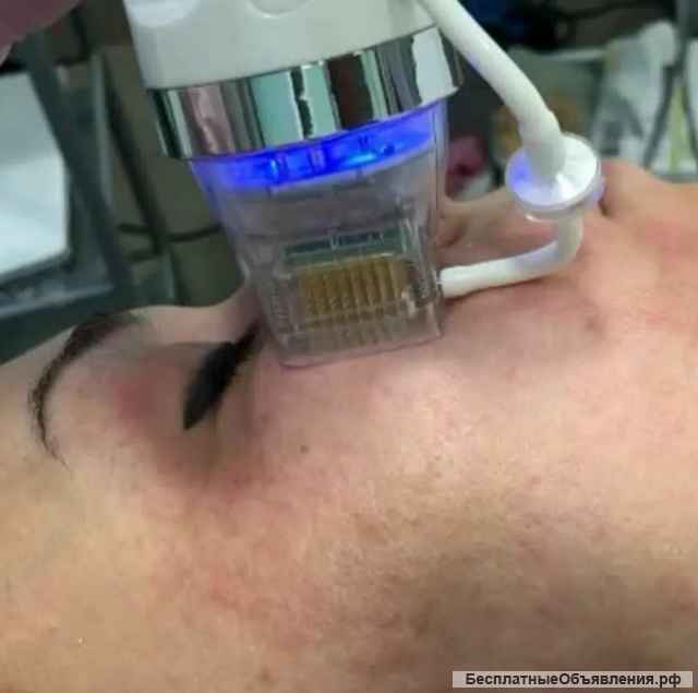 Мик­ро­иголь­ча­тый ра­ди­овол­но­вой лиф­тинг - омо­ложе­ние ко­жи