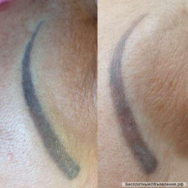 Удаление татуажа, тату, перманента