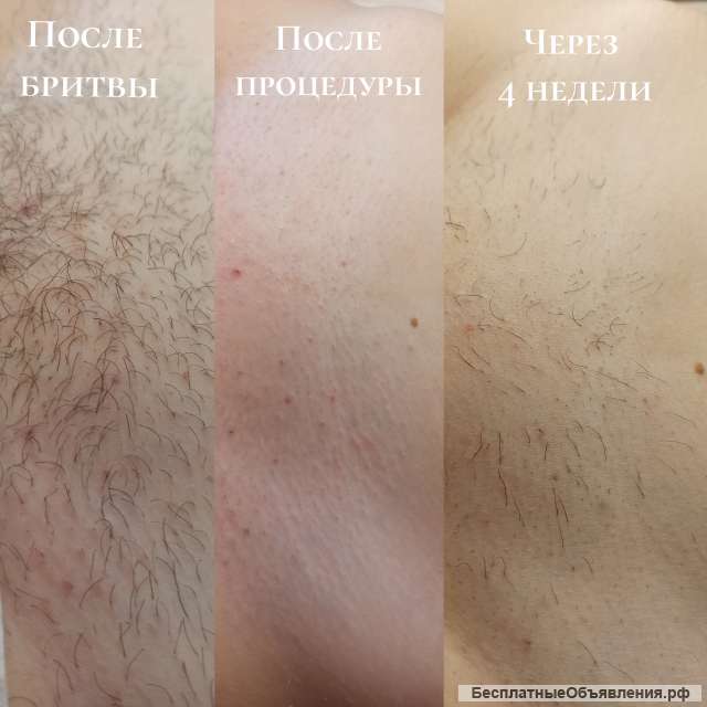 Депиляция ВОСК ШУГАРИНГ Воскресенск