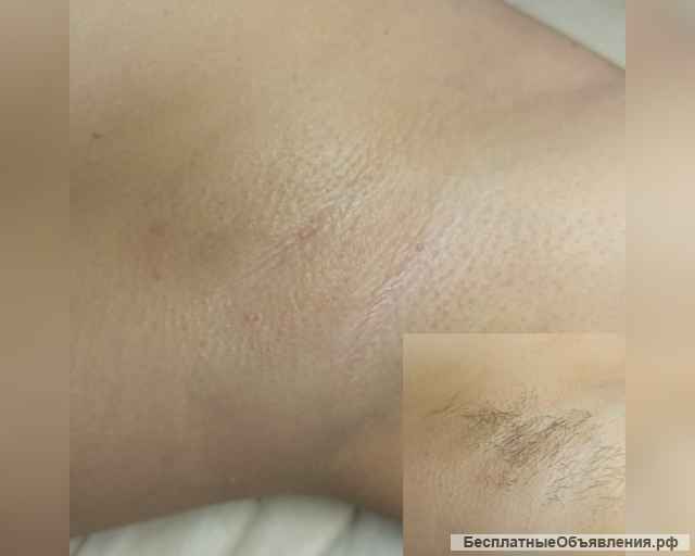 Депиляция ВОСК ШУГАРИНГ Воскресенск